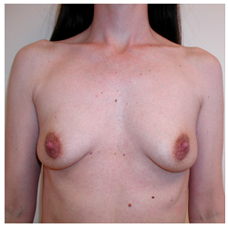 Breast Augmentation Before & After Patient #3033