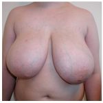 Breast Reduction Before & After Patient #3020