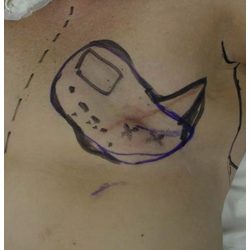 Latissimus Flap Breast Reconstruction Before & After Patient #2549