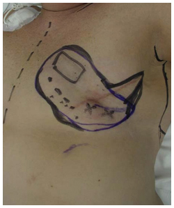 Latissimus Flap Breast Reconstruction Before & After Patient #2549