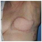 Latissimus Flap Breast Reconstruction Before & After Patient #2549