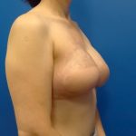 Latissimus Flap with Implant Before & After Patient #2709