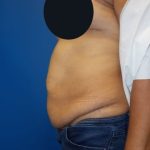 Tummy Tuck Before & After Patient #2885