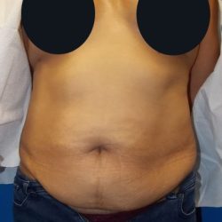 Tummy Tuck Before & After Patient #2885