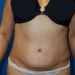 Tummy Tuck Before & After Patient #2885