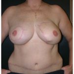 TRAM Flap Breast Reconstruction Before & After Patient #2458