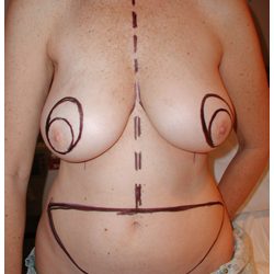 TRAM Flap Breast Reconstruction Before & After Patient #2465