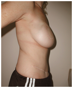 TRAM Flap Breast Reconstruction Before & After Patient #2465