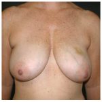 TRAM Flap Breast Reconstruction Before & After Patient #2600