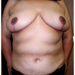 TRAM Flap Breast Reconstruction Before & After Patient #2621