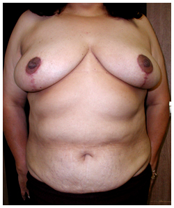 TRAM Flap Breast Reconstruction Before & After Patient #2621