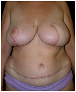 TRAM Flap Breast Reconstruction Before & After Patient #2633