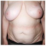 TRAM Flap Breast Reconstruction Before & After Patient #2670