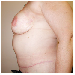 TRAM Flap Breast Reconstruction Before & After Patient #2670
