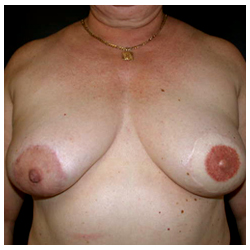 TRAM Flap Breast Reconstruction Before & After Patient #2677