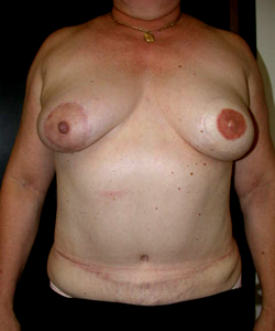 TRAM Flap Breast Reconstruction Before & After Patient #2677
