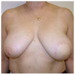 TRAM Flap Breast Reconstruction Before & After Patient #2690