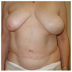 TRAM Flap Breast Reconstruction Before & After Patient #2690