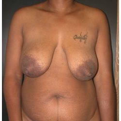 TRAM Flap Breast Reconstruction Before & After Patient #2701