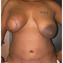TRAM Flap Breast Reconstruction Before & After Patient #2701