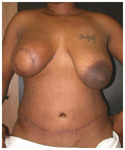 TRAM Flap Breast Reconstruction Before & After Patient #2701