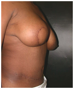 TRAM Flap Breast Reconstruction Before & After Patient #2701