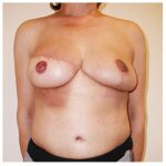 TRAM Flap Breast Reconstruction Before & After Patient #2473