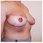 TRAM Flap Breast Reconstruction Before & After Patient #2473