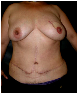 TRAM Flap Breast Reconstruction Before & After Patient #2553