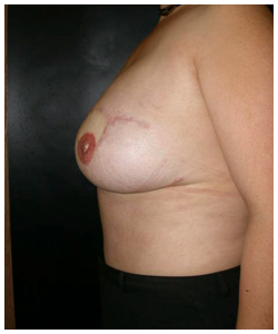 TRAM Flap Breast Reconstruction Before & After Patient #2553