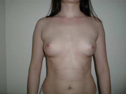 Breast Augmentation Before & After Patient #2808