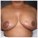 Tissue Expander To Implant Breast Reconstruction Before & After Patient #2826