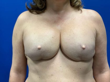 Direct to Implant Breast Reconstruction Before & After Patient #2716