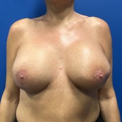 Direct to Implant Breast Reconstruction Before & After Patient #2756
