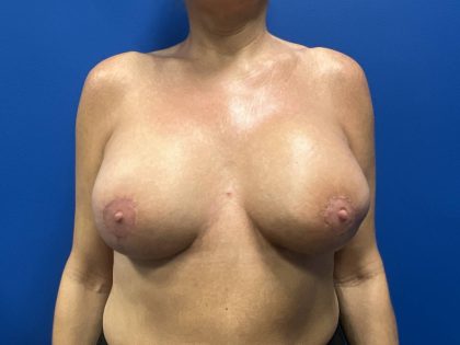 Direct to Implant Breast Reconstruction Before & After Patient #2756