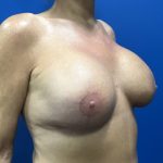 Direct to Implant Breast Reconstruction Before & After Patient #2756