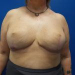 Direct to Implant Breast Reconstruction Before & After Patient #2520