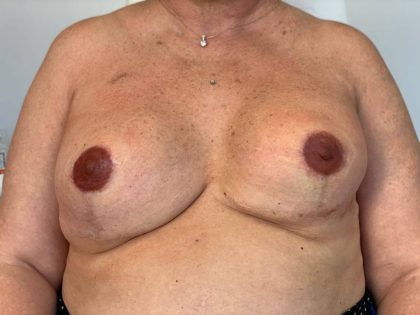 Direct to Implant Breast Reconstruction Before & After Patient #2520