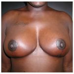 Breast Reduction Before & After Patient #2450
