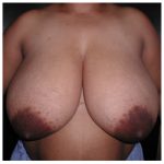 Breast Reduction Before & After Patient #2451