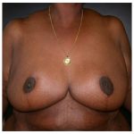 Breast Reduction Before & After Patient #2454
