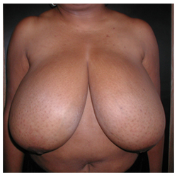 Breast Reduction Before & After Patient #2455