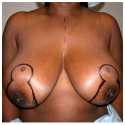 Breast Reduction Before & After Patient #2444