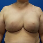 Direct to Implant Breast Reconstruction Before & After Patient #2501