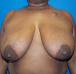Latissimus Flap with Implant Before & After Patient #2717