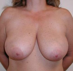 Direct to Implant Breast Reconstruction Before & After Patient #2716