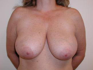 Direct to Implant Breast Reconstruction Before & After Patient #2716