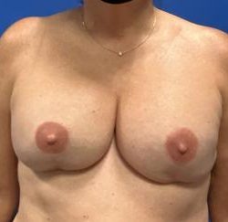 Direct to Implant Breast Reconstruction Before & After Patient #2716