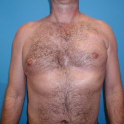Poland Syndrome Before & After Patient #3202