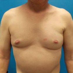 Poland Syndrome Before & After Patient #3166